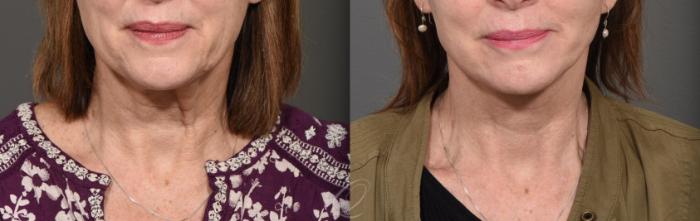 Facelift Case 1412 Before & After Front | Serving Rochester, Syracuse & Buffalo, NY | Quatela Center for Plastic Surgery