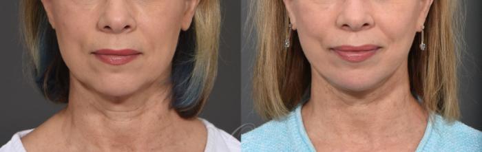 Facelift Case 1413 Before & After Front | Serving Rochester, Syracuse & Buffalo, NY | Quatela Center for Plastic Surgery
