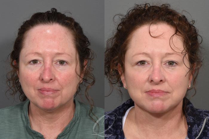 Facelift Case 1414 Before & After Front | Serving Rochester, Syracuse & Buffalo, NY | Quatela Center for Plastic Surgery