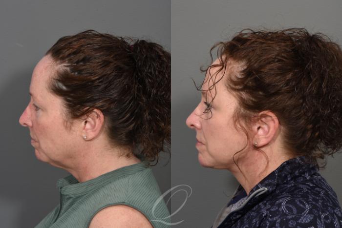 Facelift Case 1414 Before & After Left Side | Serving Rochester, Syracuse & Buffalo, NY | Quatela Center for Plastic Surgery