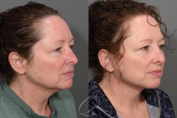 Facelift Case 1414 Before & After Right Oblique | Serving Rochester, Syracuse & Buffalo, NY | Quatela Center for Plastic Surgery