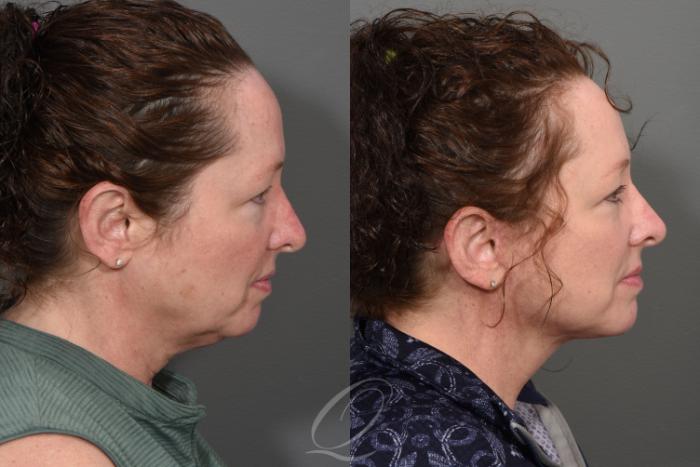 Facelift Case 1414 Before & After Right Side | Serving Rochester, Syracuse & Buffalo, NY | Quatela Center for Plastic Surgery