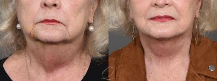 Facelift Case 1420 Before & After Front | Serving Rochester, Syracuse & Buffalo, NY | Quatela Center for Plastic Surgery
