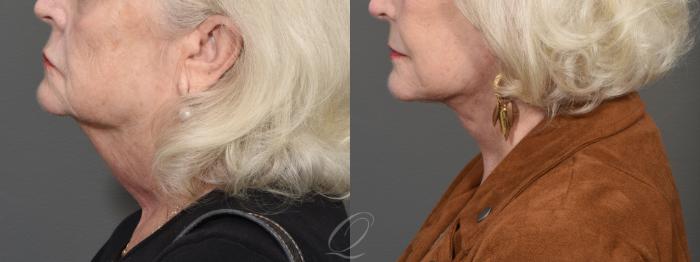 Facelift Case 1420 Before & After Left Side | Serving Rochester, Syracuse & Buffalo, NY | Quatela Center for Plastic Surgery