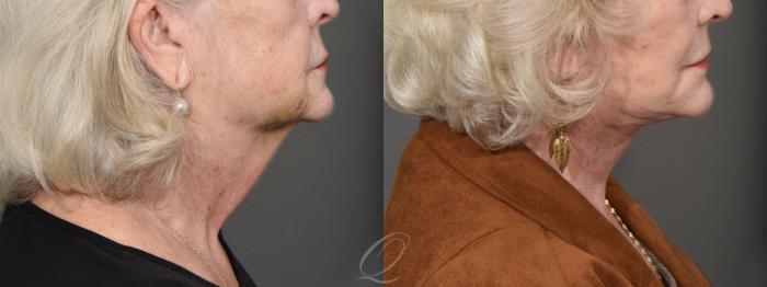 Neck Liposuction Case 1420 Before & After Right Side | Serving Rochester, Syracuse & Buffalo, NY | Quatela Center for Plastic Surgery