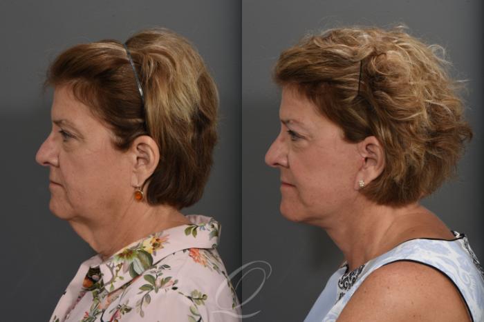 Facelift Case 1424 Before & After Left Side | Serving Rochester, Syracuse & Buffalo, NY | Quatela Center for Plastic Surgery