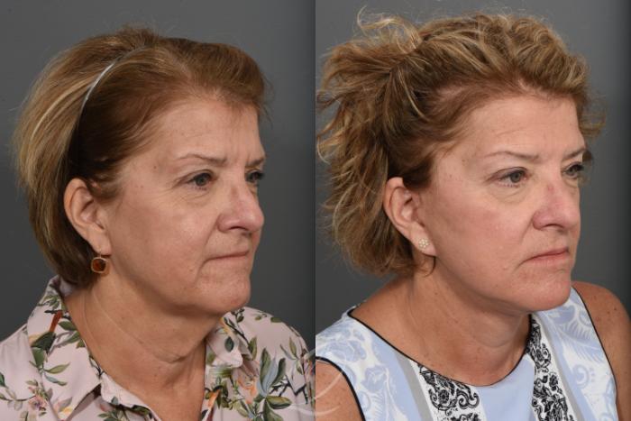 Facelift Case 1424 Before & After Right Oblique | Serving Rochester, Syracuse & Buffalo, NY | Quatela Center for Plastic Surgery