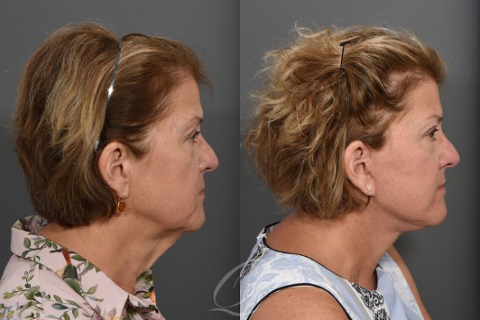 Facelift Case 1424 Before & After Right Side | Serving Rochester, Syracuse & Buffalo, NY | Quatela Center for Plastic Surgery