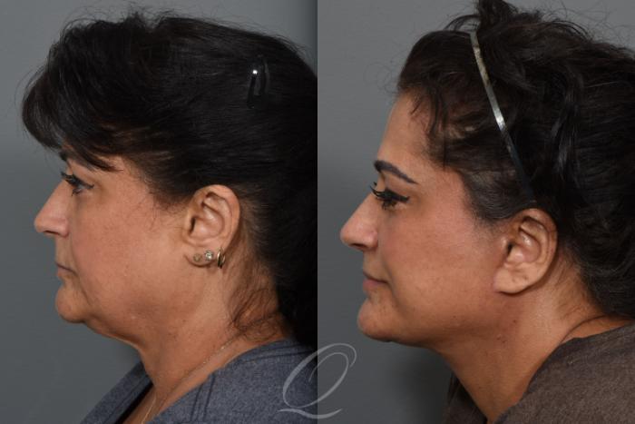 Lip Lift Case 1426 Before & After Left Side | Serving Rochester, Syracuse & Buffalo, NY | Quatela Center for Plastic Surgery