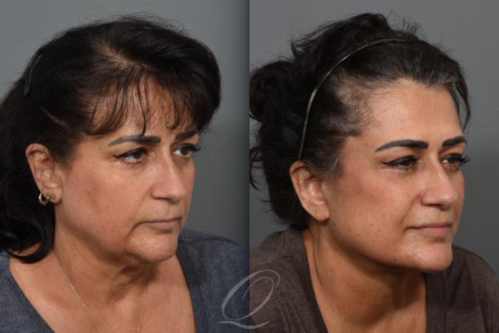 Facelift Case 1426 Before & After Right Oblique | Serving Rochester, Syracuse & Buffalo, NY | Quatela Center for Plastic Surgery