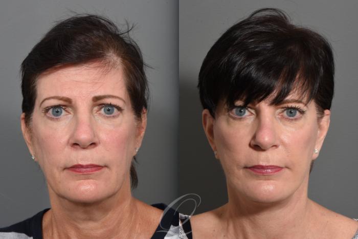 Facelift Case 1427 Before & After Front | Serving Rochester, Syracuse & Buffalo, NY | Quatela Center for Plastic Surgery