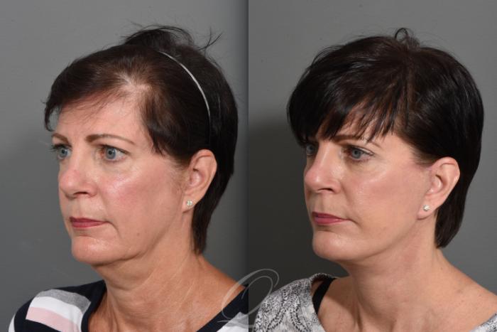 Facelift Case 1427 Before & After Left Oblique | Serving Rochester, Syracuse & Buffalo, NY | Quatela Center for Plastic Surgery