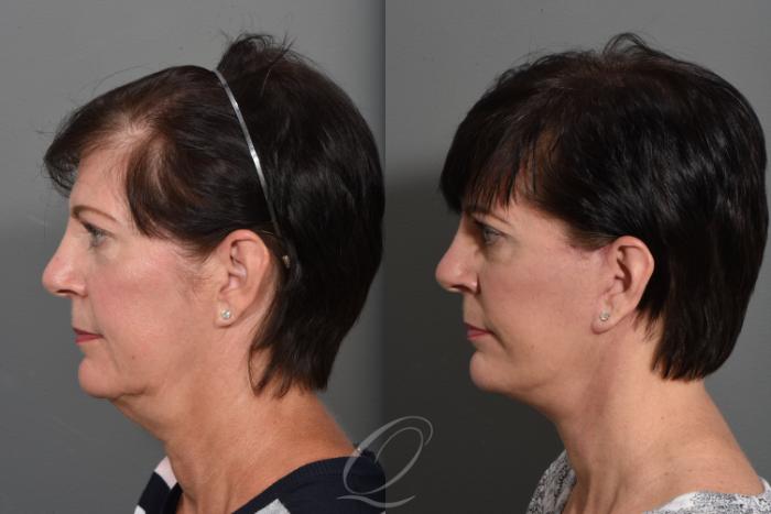 Facelift Case 1427 Before & After Left Side | Serving Rochester, Syracuse & Buffalo, NY | Quatela Center for Plastic Surgery