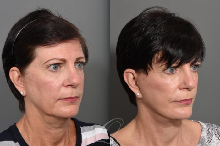 Facelift Case 1427 Before & After Right Oblique | Serving Rochester, Syracuse & Buffalo, NY | Quatela Center for Plastic Surgery