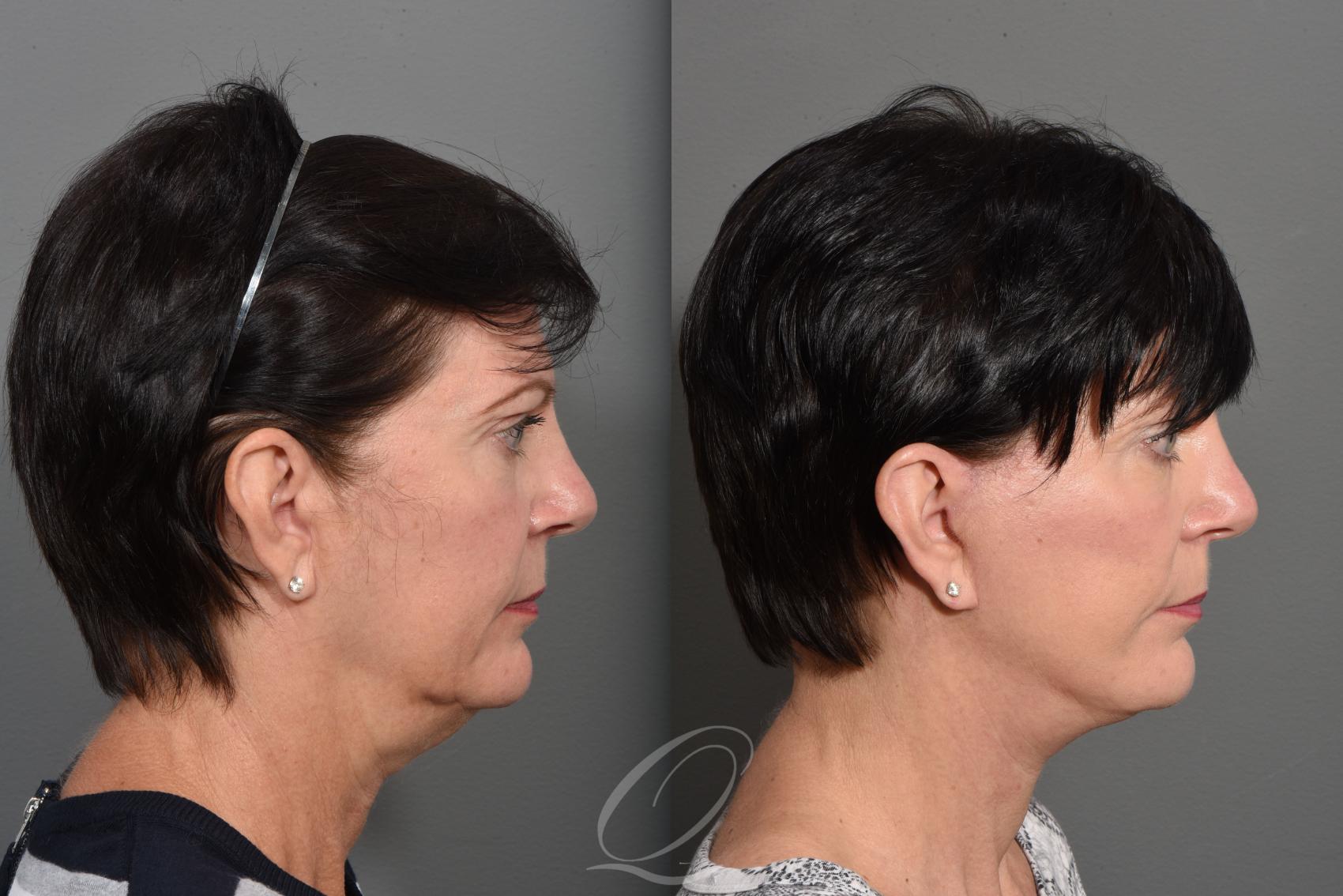 Facelift Case 1427 Before & After Right Side | Serving Rochester, Syracuse & Buffalo, NY | Quatela Center for Plastic Surgery