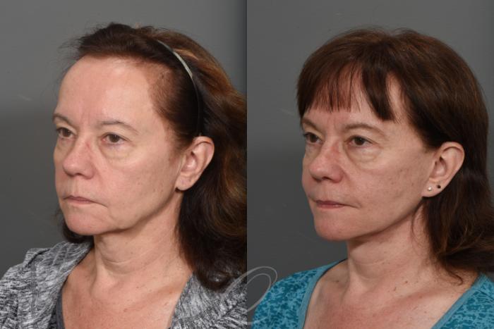 Facelift Case 1428 Before & After Left Oblique | Serving Rochester, Syracuse & Buffalo, NY | Quatela Center for Plastic Surgery