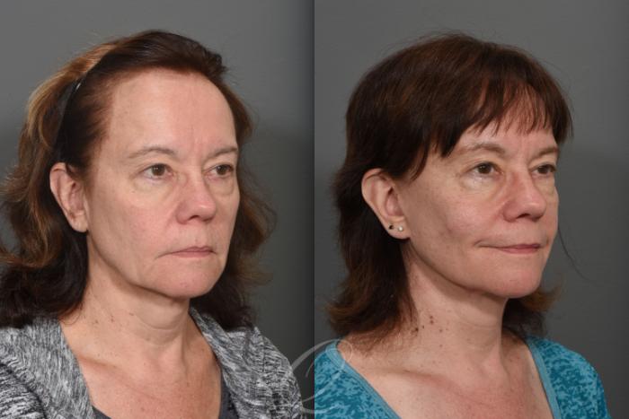Facelift Case 1428 Before & After Right Oblique | Serving Rochester, Syracuse & Buffalo, NY | Quatela Center for Plastic Surgery