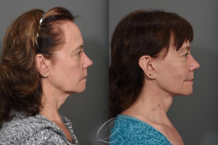 Facelift Case 1428 Before & After Right Side | Serving Rochester, Syracuse & Buffalo, NY | Quatela Center for Plastic Surgery
