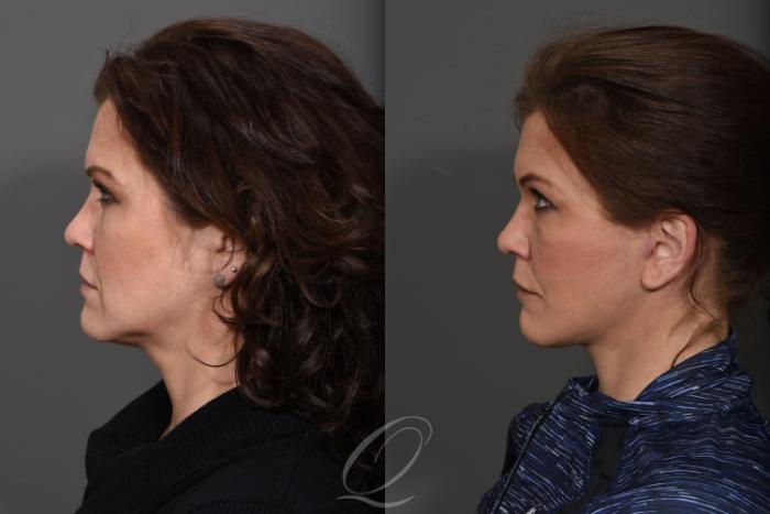 Facelift Case 1431 Before & After Left Side | Serving Rochester, Syracuse & Buffalo, NY | Quatela Center for Plastic Surgery