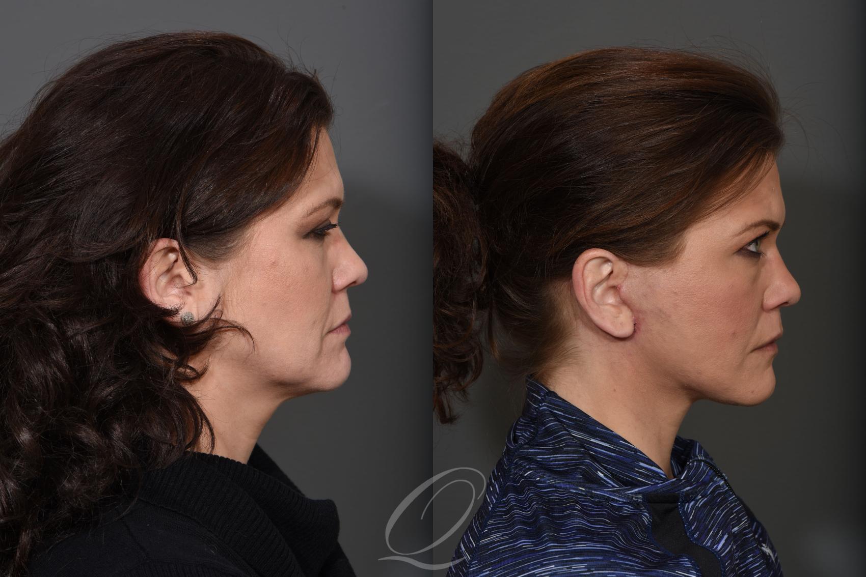 Facelift Case 1431 Before & After Right Side | Serving Rochester, Syracuse & Buffalo, NY | Quatela Center for Plastic Surgery