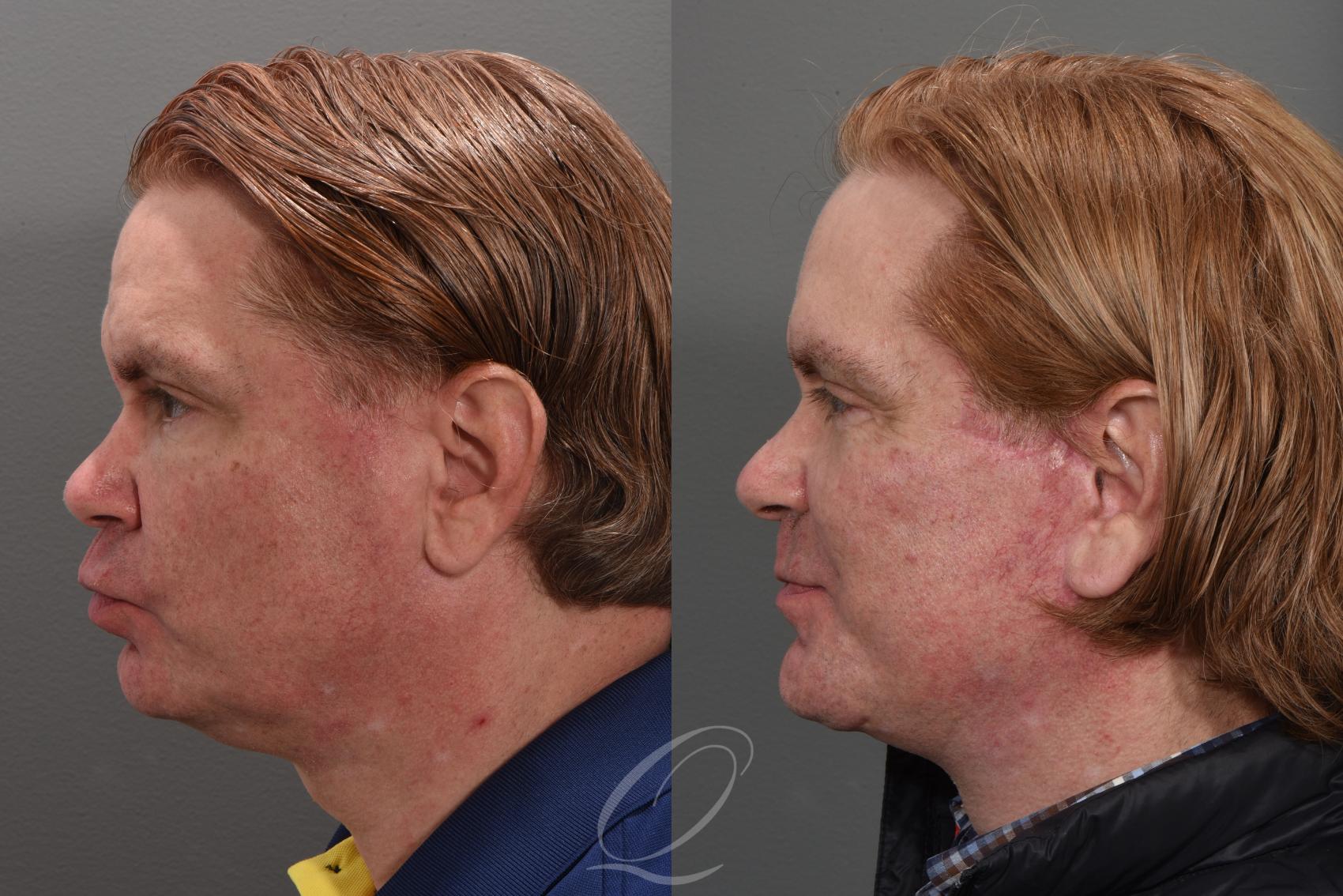 Neck Liposuction Case 1432 Before & After Left Side | Serving Rochester, Syracuse & Buffalo, NY | Quatela Center for Plastic Surgery
