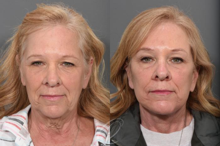 Facelift Case 1433 Before & After Front | Serving Rochester, Syracuse & Buffalo, NY | Quatela Center for Plastic Surgery