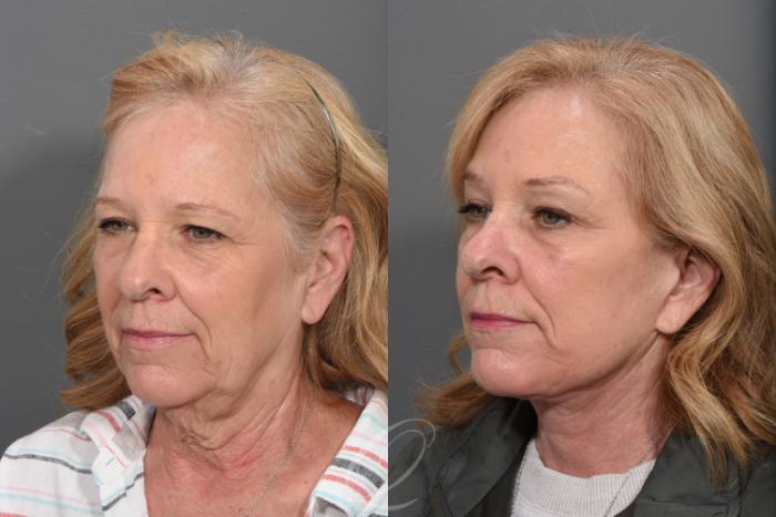 Facelift Case 1433 Before & After Left Oblique | Serving Rochester, Syracuse & Buffalo, NY | Quatela Center for Plastic Surgery