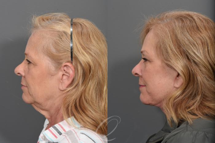 Facelift Case 1433 Before & After Left Side | Serving Rochester, Syracuse & Buffalo, NY | Quatela Center for Plastic Surgery
