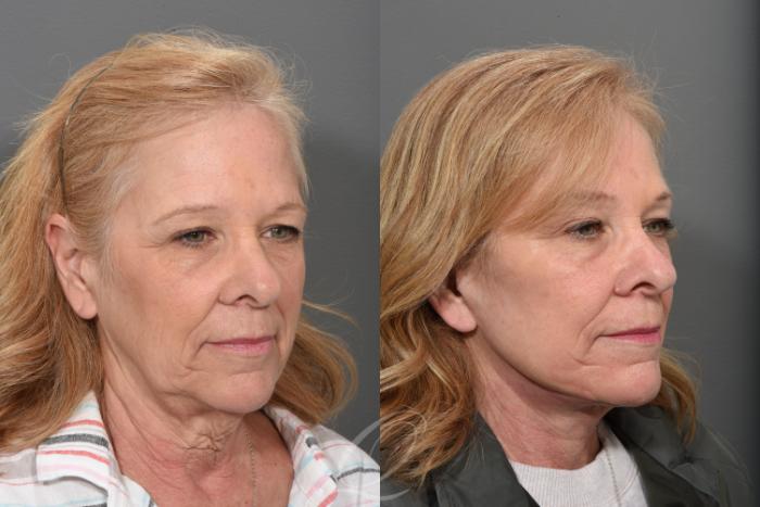 Facelift Case 1433 Before & After Right Oblique | Serving Rochester, Syracuse & Buffalo, NY | Quatela Center for Plastic Surgery