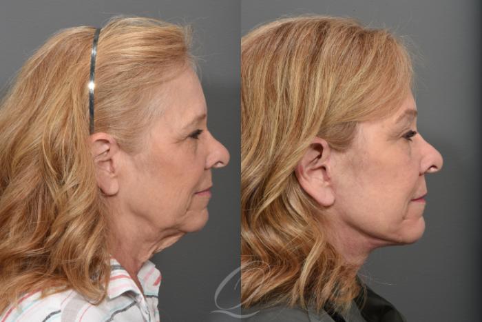 Facelift Case 1433 Before & After Right Side | Serving Rochester, Syracuse & Buffalo, NY | Quatela Center for Plastic Surgery