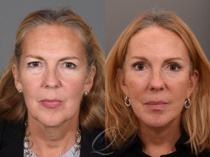 Facelift Case 1461 Before & After Front | Serving Rochester, Syracuse & Buffalo, NY | Quatela Center for Plastic Surgery