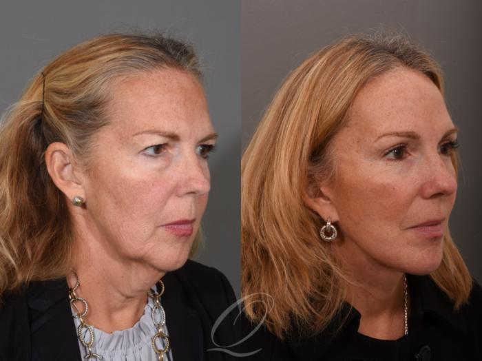 Facelift Case 1461 Before & After Right Oblique | Serving Rochester, Syracuse & Buffalo, NY | Quatela Center for Plastic Surgery