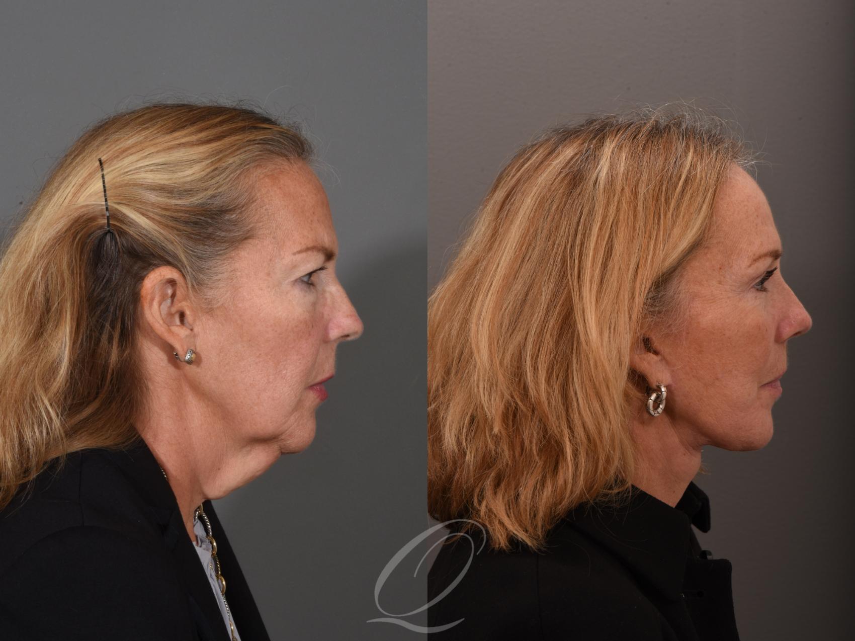 Brow Lift Case 1461 Before & After Right Side | Serving Rochester, Syracuse & Buffalo, NY | Quatela Center for Plastic Surgery