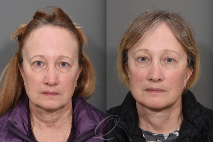Facelift Case 1465 Before & After Front | Serving Rochester, Syracuse & Buffalo, NY | Quatela Center for Plastic Surgery