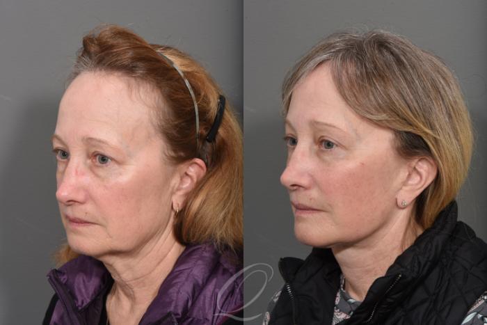 Facelift Case 1465 Before & After Left Oblique | Serving Rochester, Syracuse & Buffalo, NY | Quatela Center for Plastic Surgery
