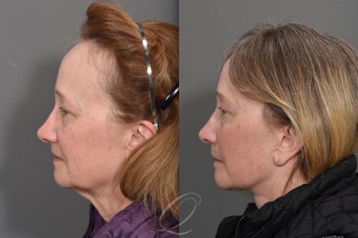 Facelift Case 1465 Before & After Left Side | Serving Rochester, Syracuse & Buffalo, NY | Quatela Center for Plastic Surgery