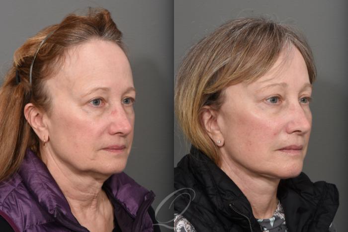 Facelift Case 1465 Before & After Right Oblique | Serving Rochester, Syracuse & Buffalo, NY | Quatela Center for Plastic Surgery