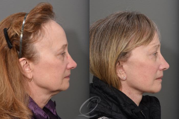 Facelift Case 1465 Before & After Right Side | Serving Rochester, Syracuse & Buffalo, NY | Quatela Center for Plastic Surgery