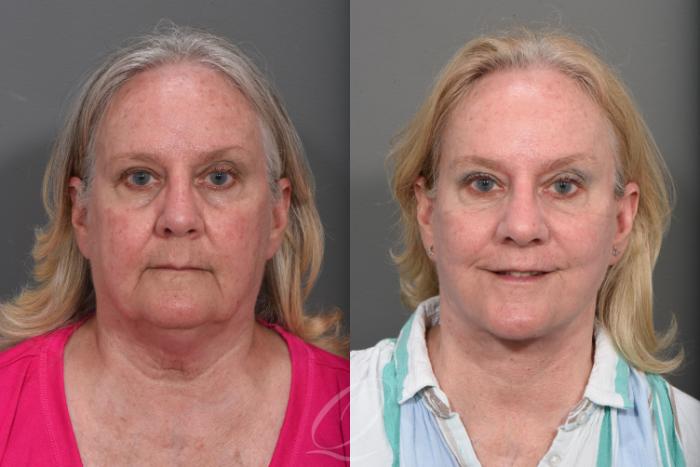 Facelift Case 1467 Before & After Front | Serving Rochester, Syracuse & Buffalo, NY | Quatela Center for Plastic Surgery