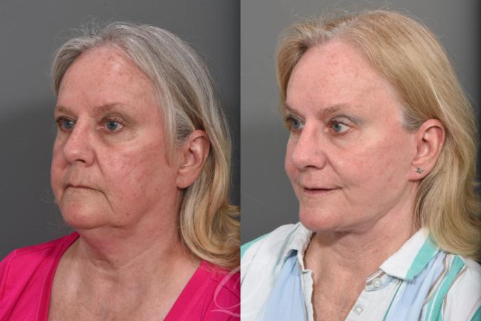 Facelift Case 1467 Before & After Left Oblique | Serving Rochester, Syracuse & Buffalo, NY | Quatela Center for Plastic Surgery