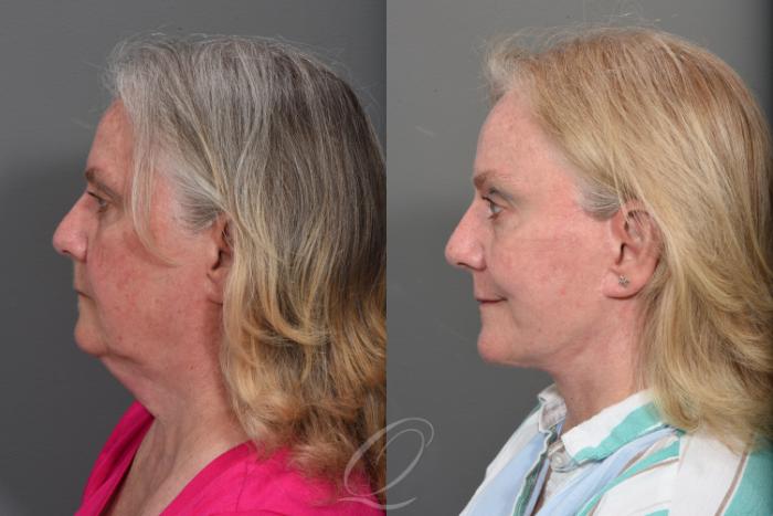 Facelift Case 1467 Before & After Left Side | Serving Rochester, Syracuse & Buffalo, NY | Quatela Center for Plastic Surgery