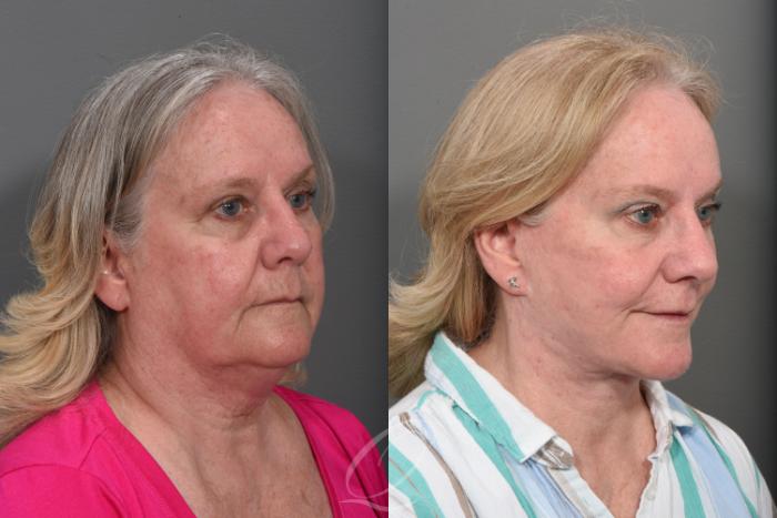 Facelift Case 1467 Before & After Right Oblique | Serving Rochester, Syracuse & Buffalo, NY | Quatela Center for Plastic Surgery