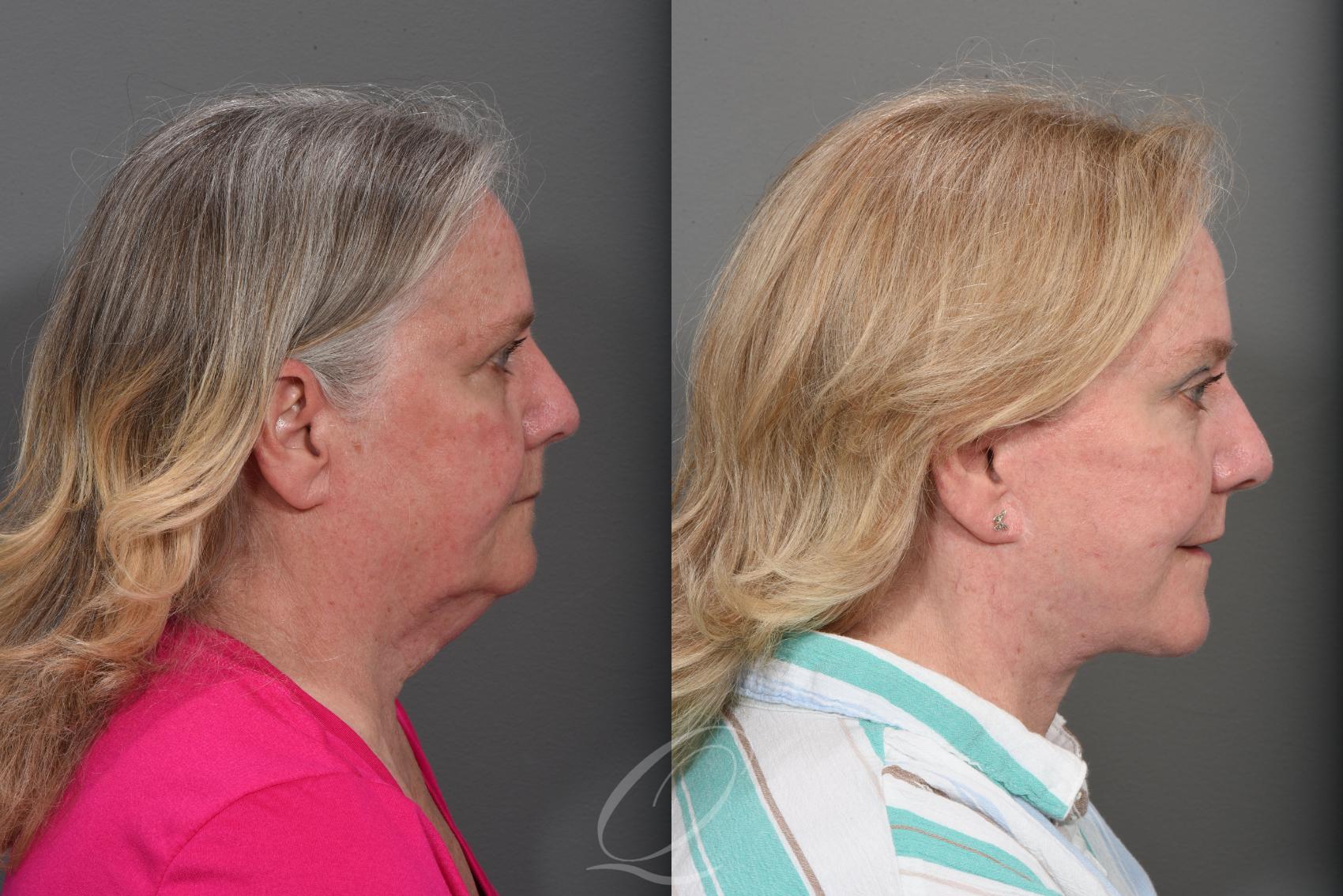 Facelift Case 1467 Before & After Right Side | Serving Rochester, Syracuse & Buffalo, NY | Quatela Center for Plastic Surgery