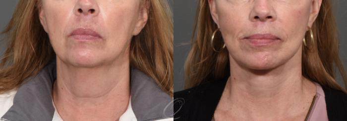 Facelift Case 1468 Before & After Front | Serving Rochester, Syracuse & Buffalo, NY | Quatela Center for Plastic Surgery