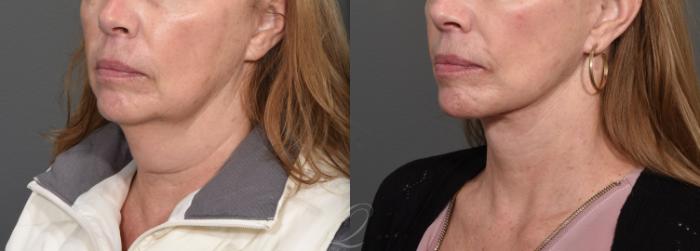 Facelift Case 1468 Before & After Left Oblique | Serving Rochester, Syracuse & Buffalo, NY | Quatela Center for Plastic Surgery