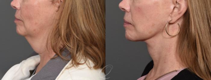 Facelift Case 1468 Before & After Left Side | Serving Rochester, Syracuse & Buffalo, NY | Quatela Center for Plastic Surgery
