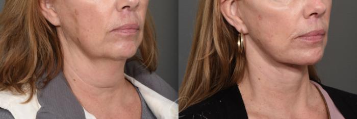 Facelift Case 1468 Before & After Right Oblique | Serving Rochester, Syracuse & Buffalo, NY | Quatela Center for Plastic Surgery