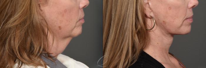 Facelift Case 1468 Before & After Right Side | Serving Rochester, Syracuse & Buffalo, NY | Quatela Center for Plastic Surgery