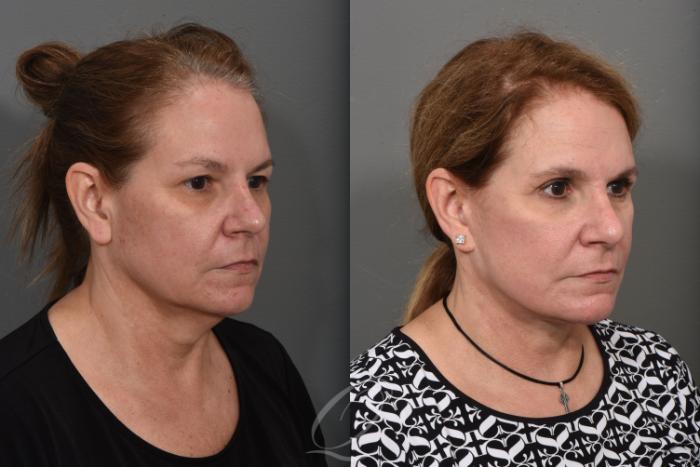 Facelift Case 1469 Before & After Right Oblique | Serving Rochester, Syracuse & Buffalo, NY | Quatela Center for Plastic Surgery