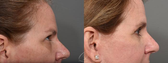 Facelift Case 1469 Before & After Right Side Close-Up | Serving Rochester, Syracuse & Buffalo, NY | Quatela Center for Plastic Surgery